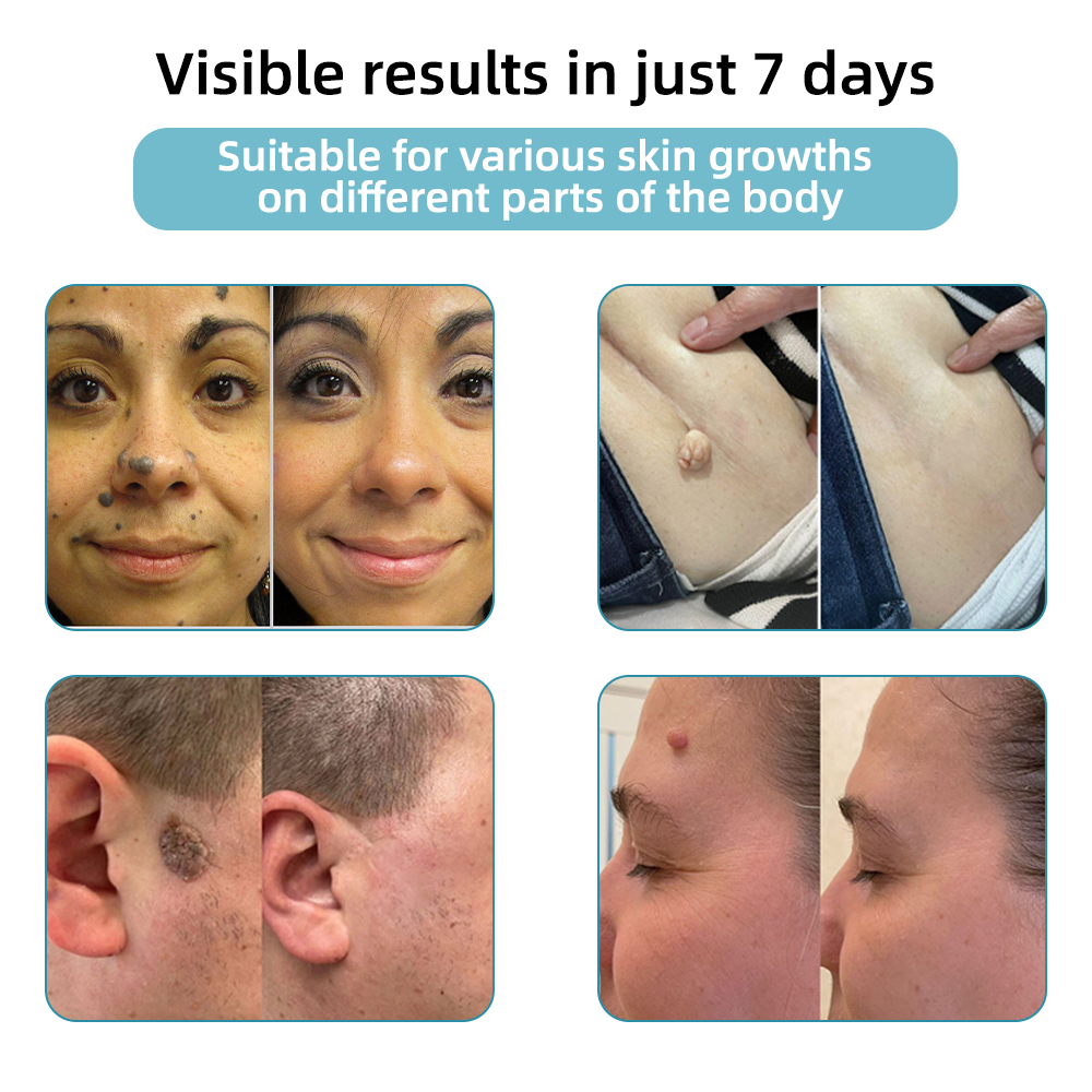 SkinClear Pro™ - Erase Embarrassing Skin Blemishes Forever (+ FREE Mystery Gift)