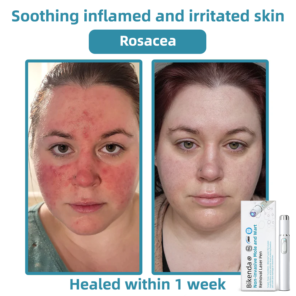 SkinClear Pro™ - Erase Embarrassing Skin Blemishes Forever (+ FREE Mystery Gift)