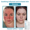 SkinClear Pro™ - Erase Embarrassing Skin Blemishes Forever (+ FREE Mystery Gift)