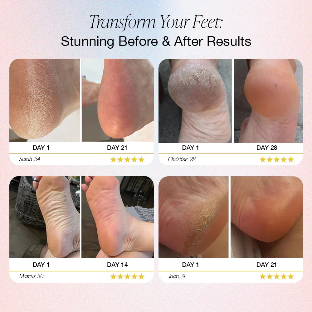 SoftPedi Pro™ - Transform Rough, Embarrassing Feet Into Baby-Soft Perfection (+ FREE Mystery Gift)
