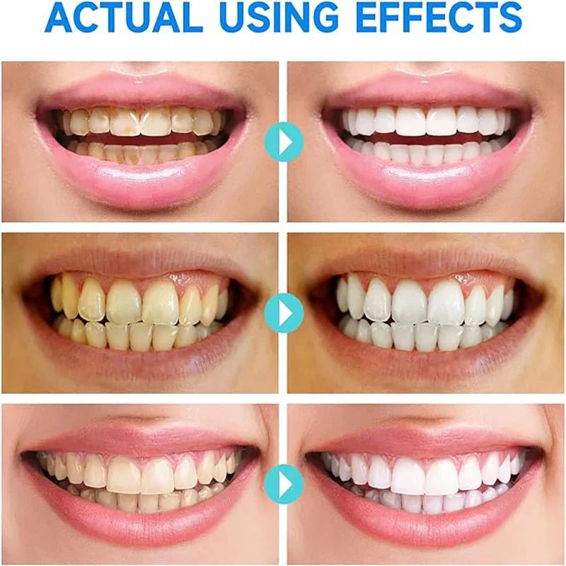 PureTeeth™ - Transform Yellow Teeth to Celebrity White in Just 7 Days (+ FREE Mystery bonus)